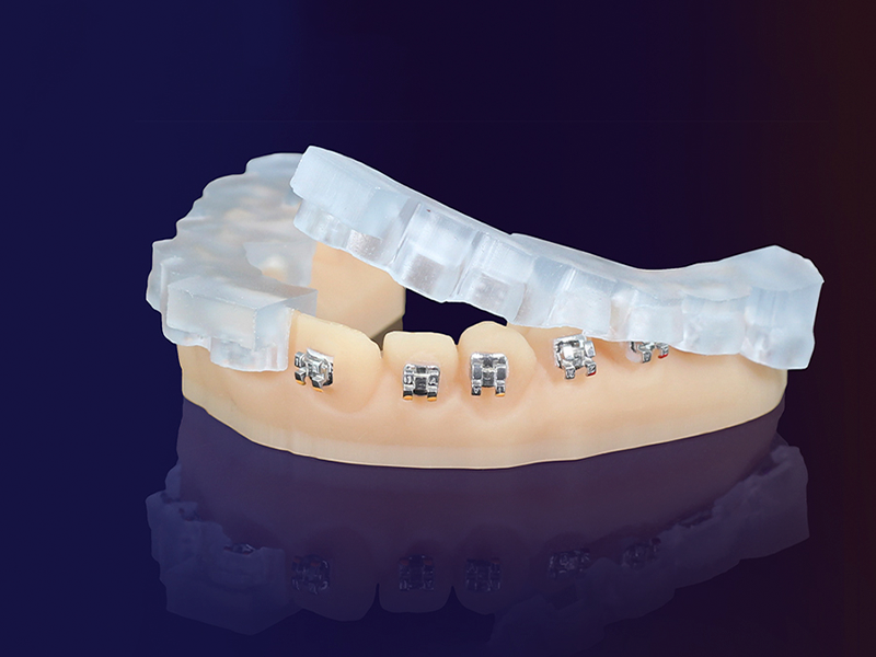 Ein indirektes Bondingsystem auf einem Zahnmodell